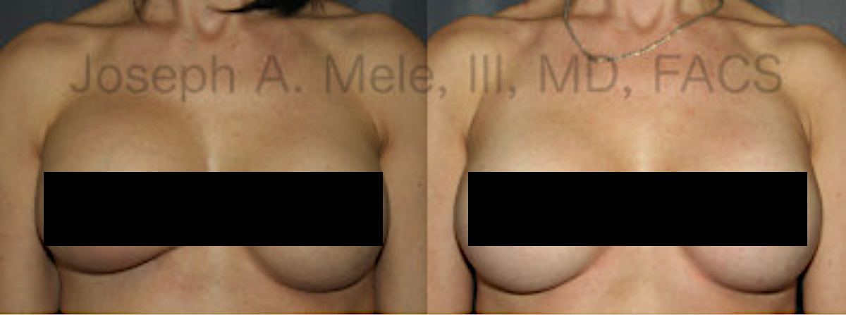 Breast Augmentation Revision Before and After Censored
