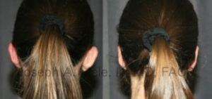 Otoplasty before and after pictures showing the correction of prominent ears.