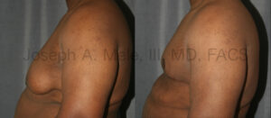 Massive Male Breast Reduction after weight loss.