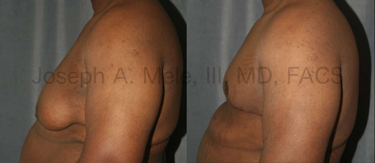 Massive Male Breast Reduction after weight loss.