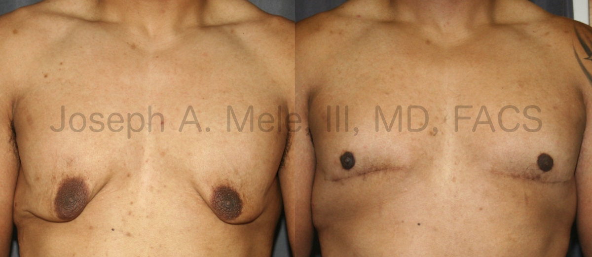 Massive Male Breast Reduction after weight loss.