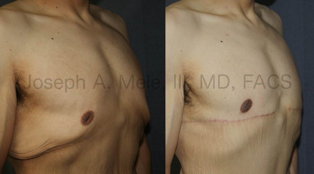 Massive Male Breast Reduction after weight loss.