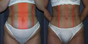 Tummy Tuck Before and After Pictures - Muscle Tightening