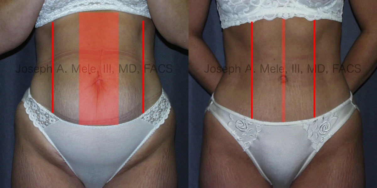 Tummy Tuck Before and After Pictures - Muscle Tightening