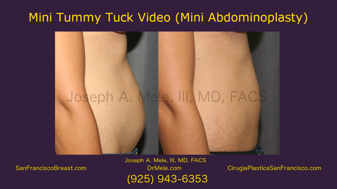 Mini Tummy Tuck Video (Mini Abdominoplasty) with before and after pictures