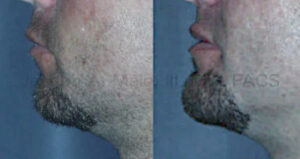 Before and After Chin Augmentation with Chin Implant - Male