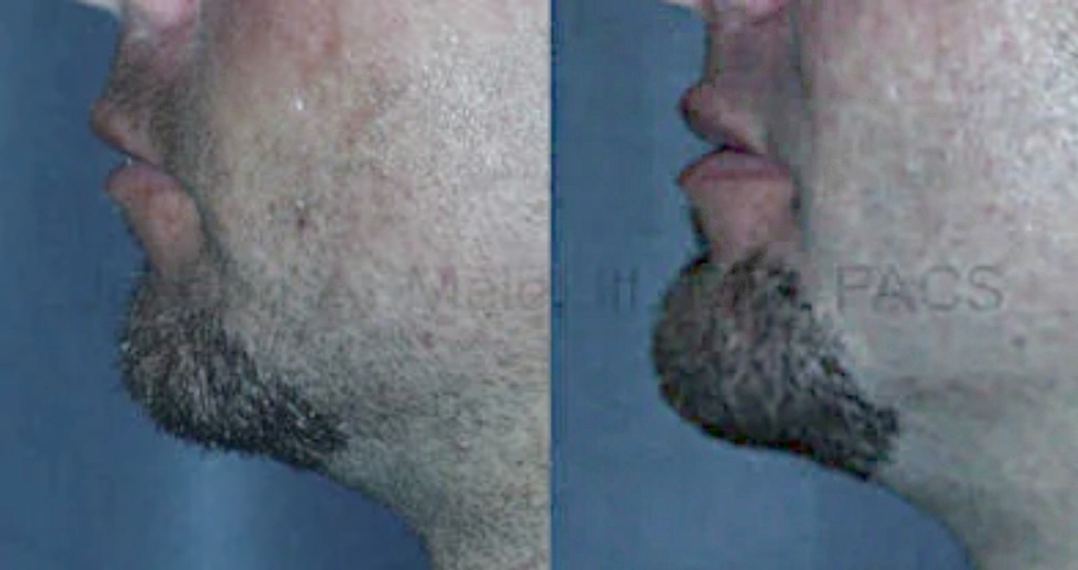 Before and After Chin Augmentation with Chin Implant - Male