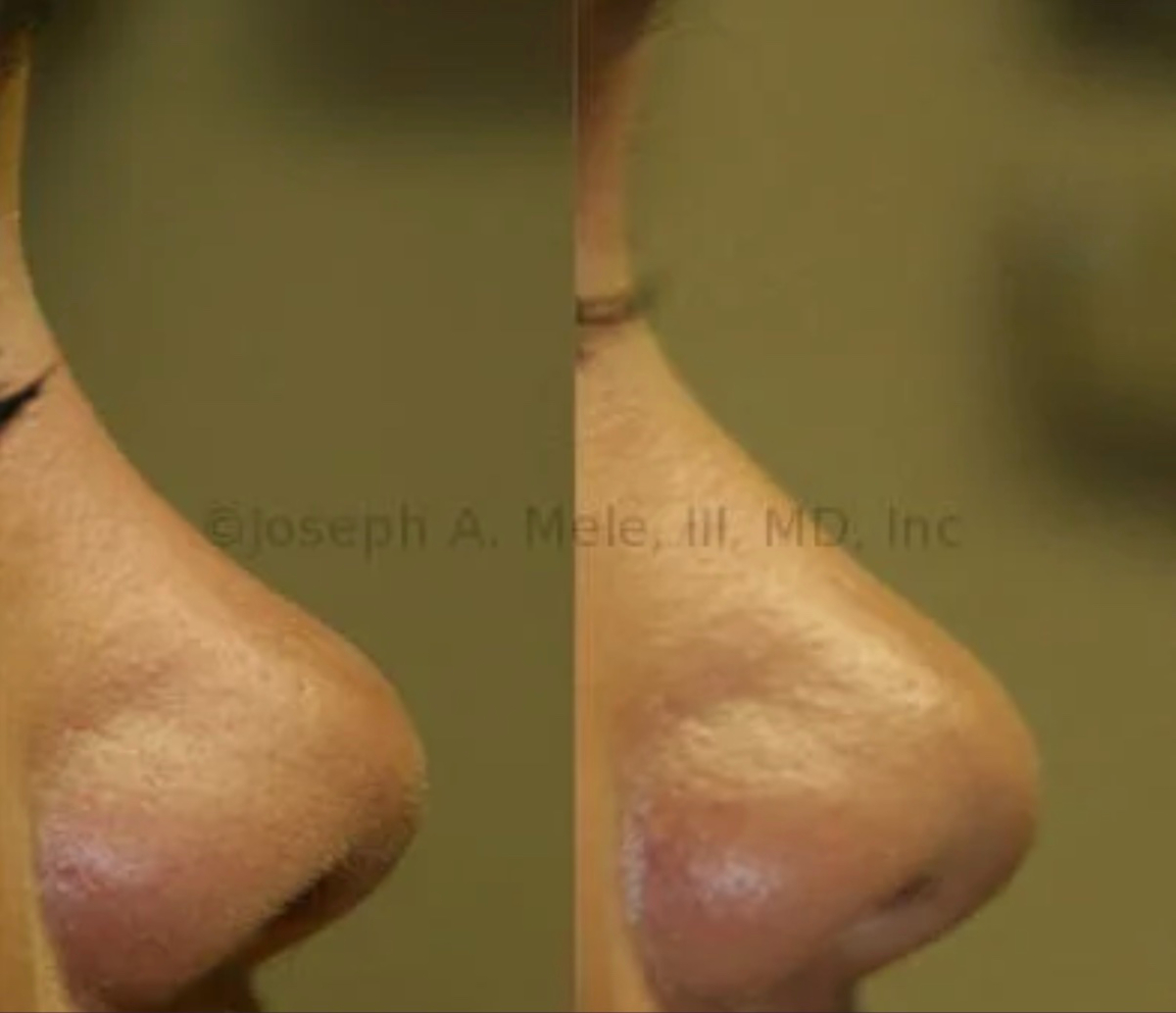 Dorsal Nasal Augmentation with Filler