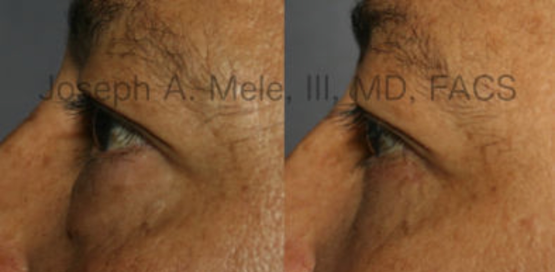 Eyelid Lift Before and After Pictures (Blepharoplasty)