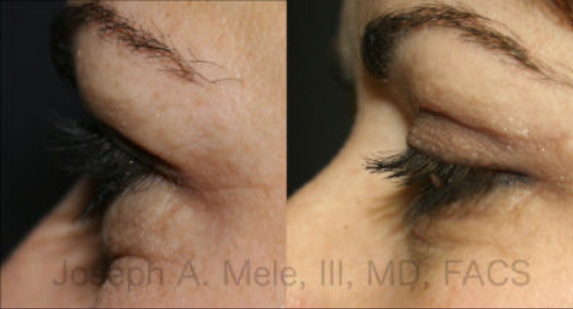 Eyelid Lift Before and After Pictures (Blepharoplasty)