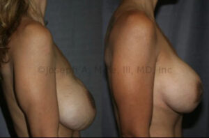 Breast Implant Malposition - Bottoming Out