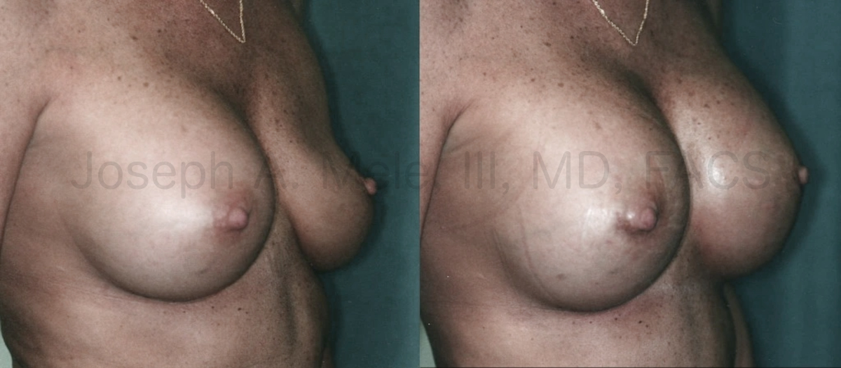 Breast Implant Deflation