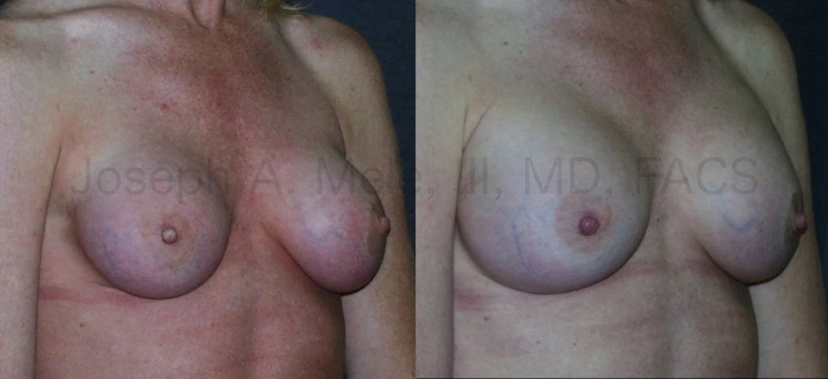 Capsular Contracture and Capsulectomy breast implant revision before and after pictures