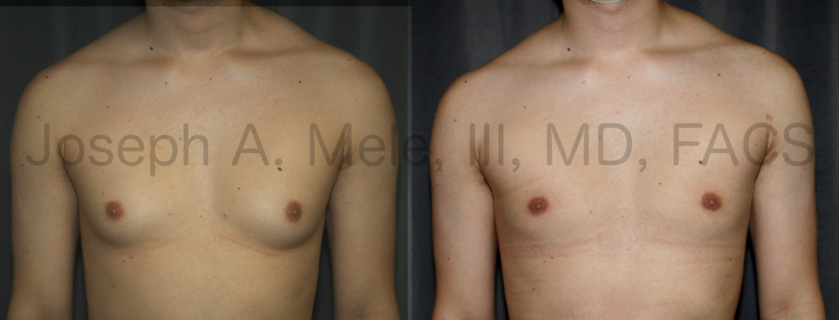 Gynecomastia Reduction Before and After Pictures (Male Breast Reduction)
