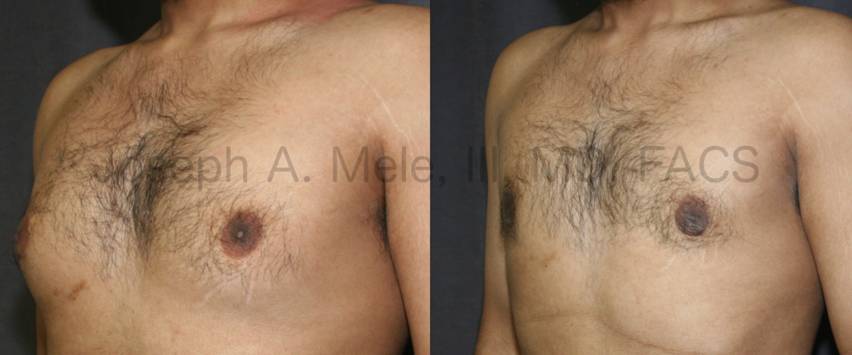 Gynecomastia Reduction Before and After Pictures (Male Breast Reduction)