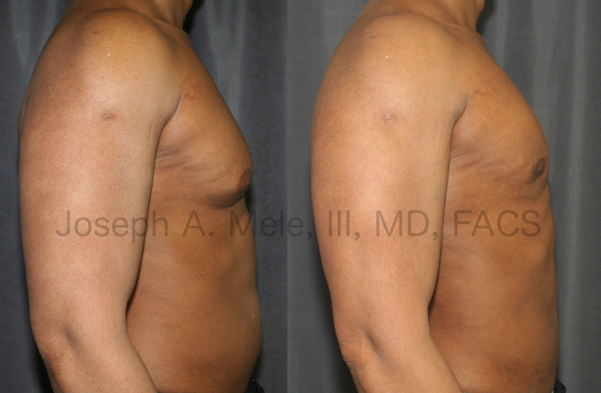 Gynecomastia Reduction Before and After Pictures (Male Breast Reduction)