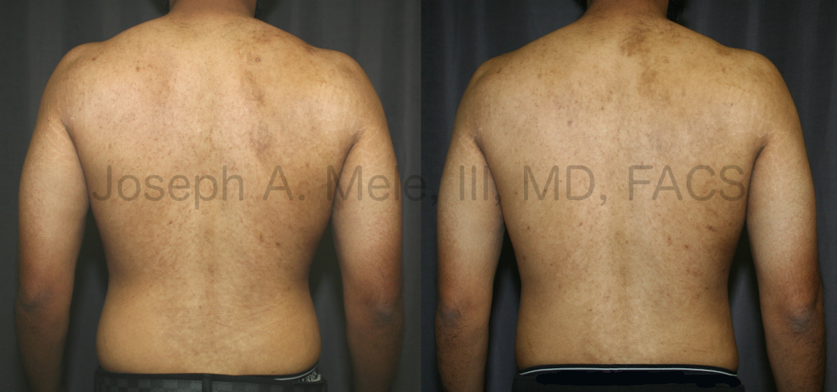 Liposuction of the Back Before and After Pictures (Male Love Handle  Reduction)