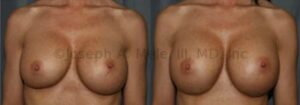 Breast Augmentation Revision - Breast Implant exchange for larger breast implants