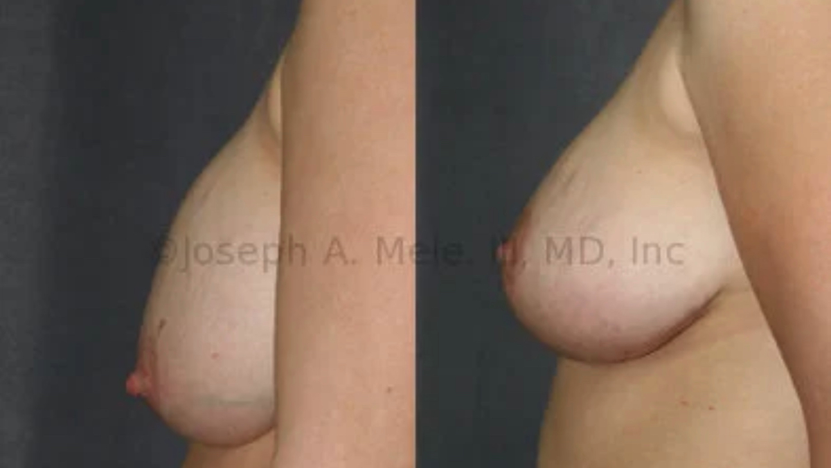 Breast Implant Revision Surgery - Breast lift over the breast implant.