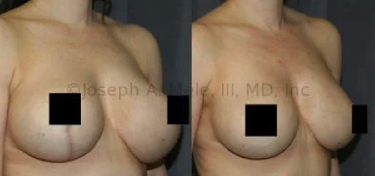 Breast Implant Revision Surgery - Breast Implant exchange with breast lift (mastopexy)