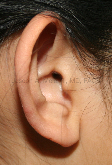 Otoplasty before and after pictures for prominent ear correction.