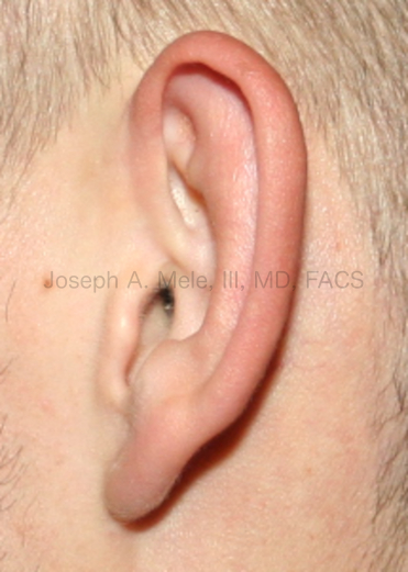 Otoplasty before and after pictures for prominent ear correction.