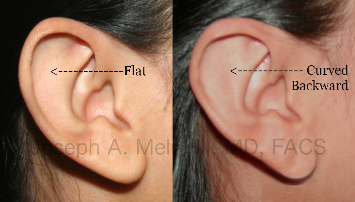 Otoplasty before and after pictures for prominent ear correction.