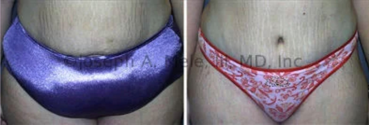 Post Bariatric Plastic Surgery Tummy Tuck Skin Tightening