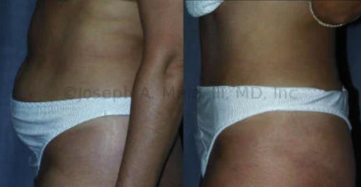 Tummy Tuck Before and After Pictures (Abdominoplasty)