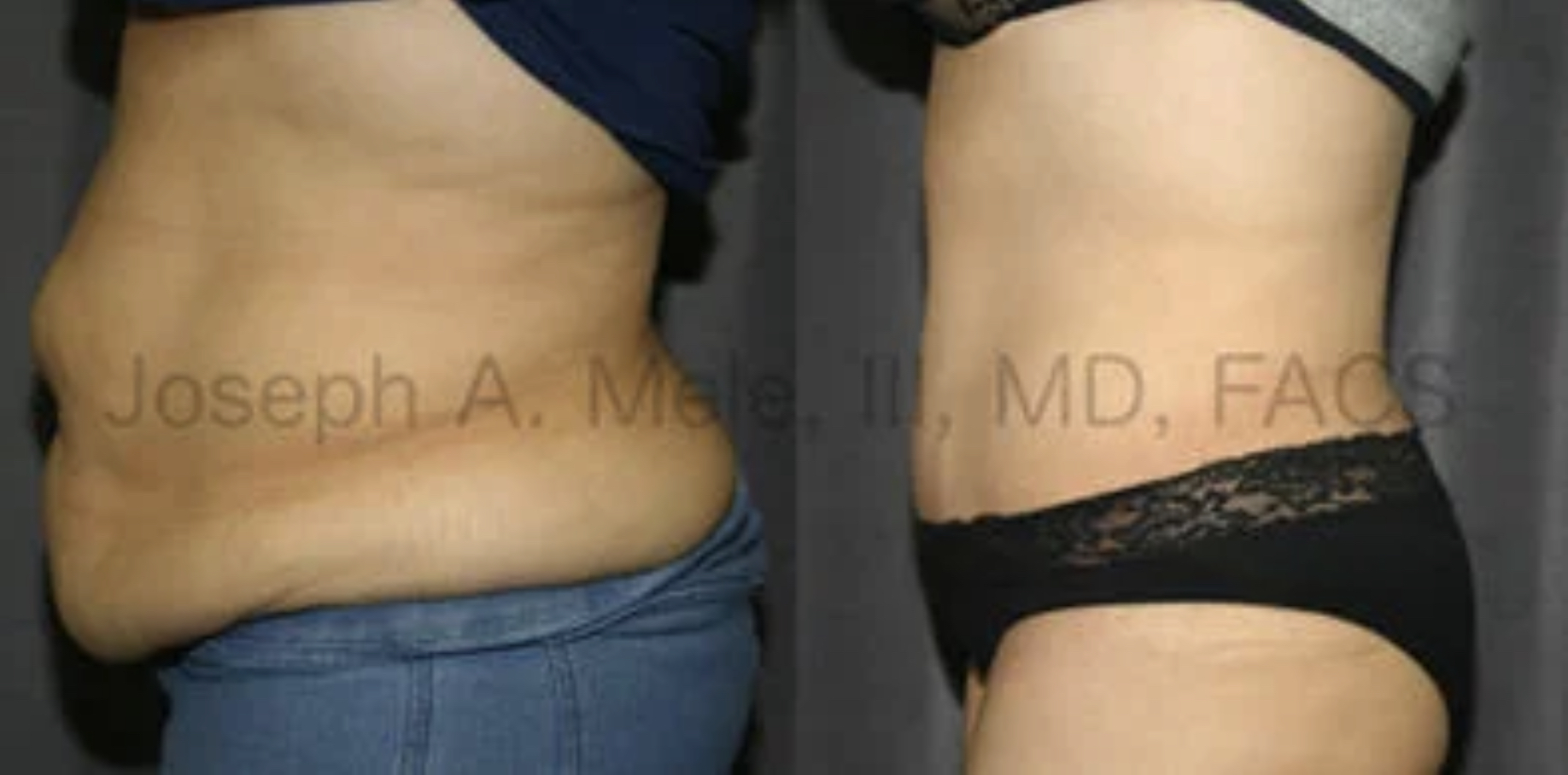 Abdominoplasty before and after Tummy Tuck