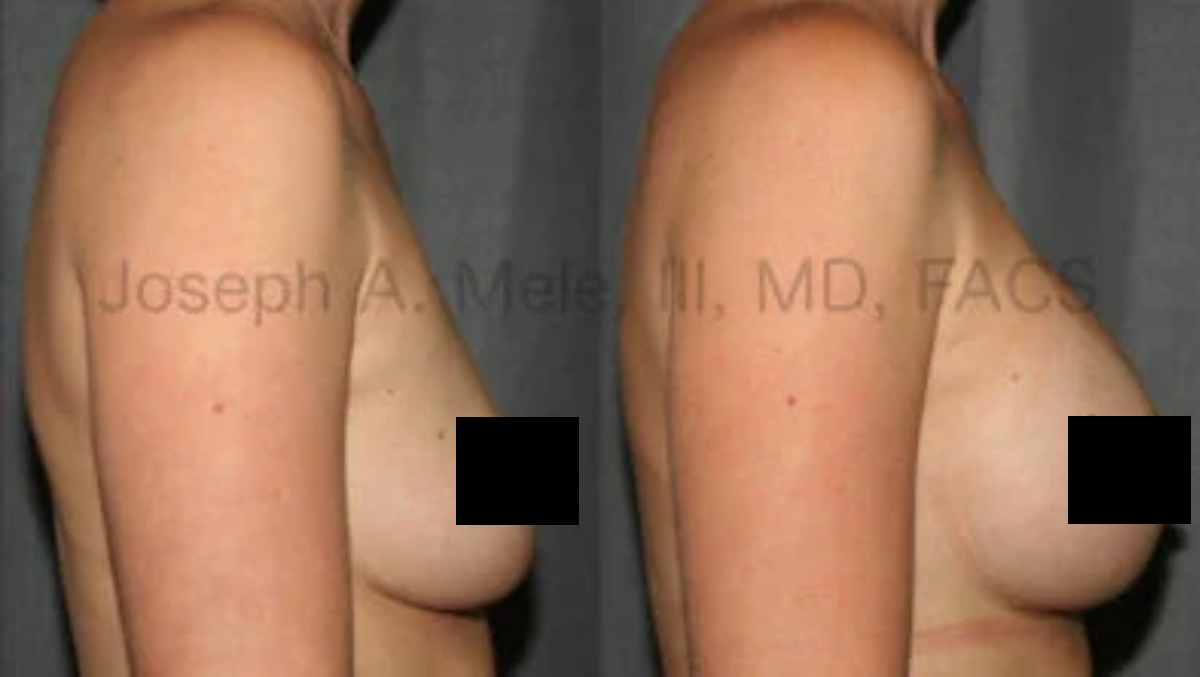 Breast Augmentation Before and After Pictures (censored)