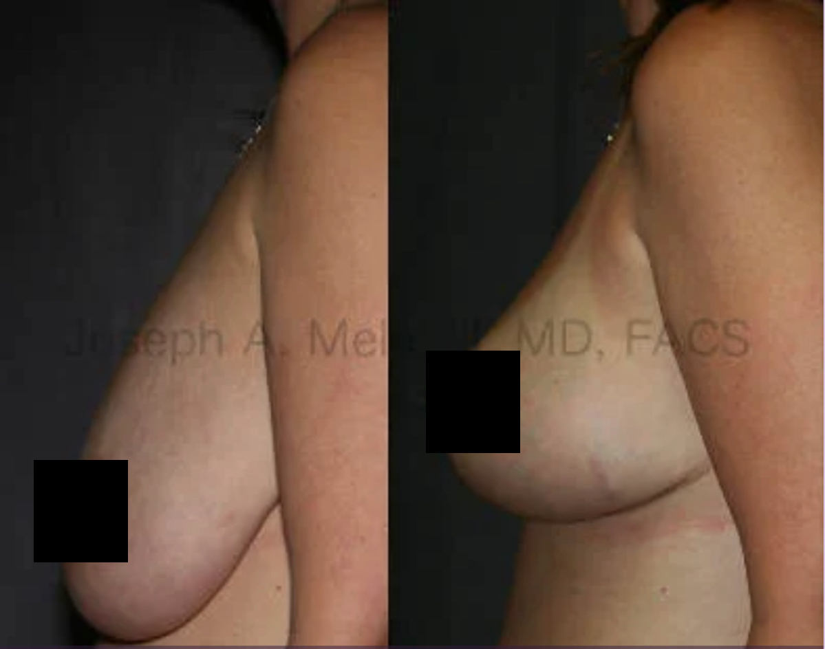 Breast Lift Before and After Pictures (censored)