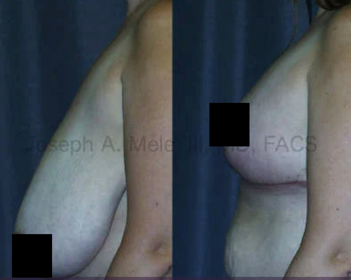 Breast Reduction Before and After Pictures (censored)