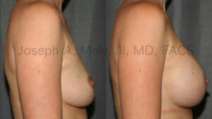 Breast Augmentation Before and After Pictures (uncensored)