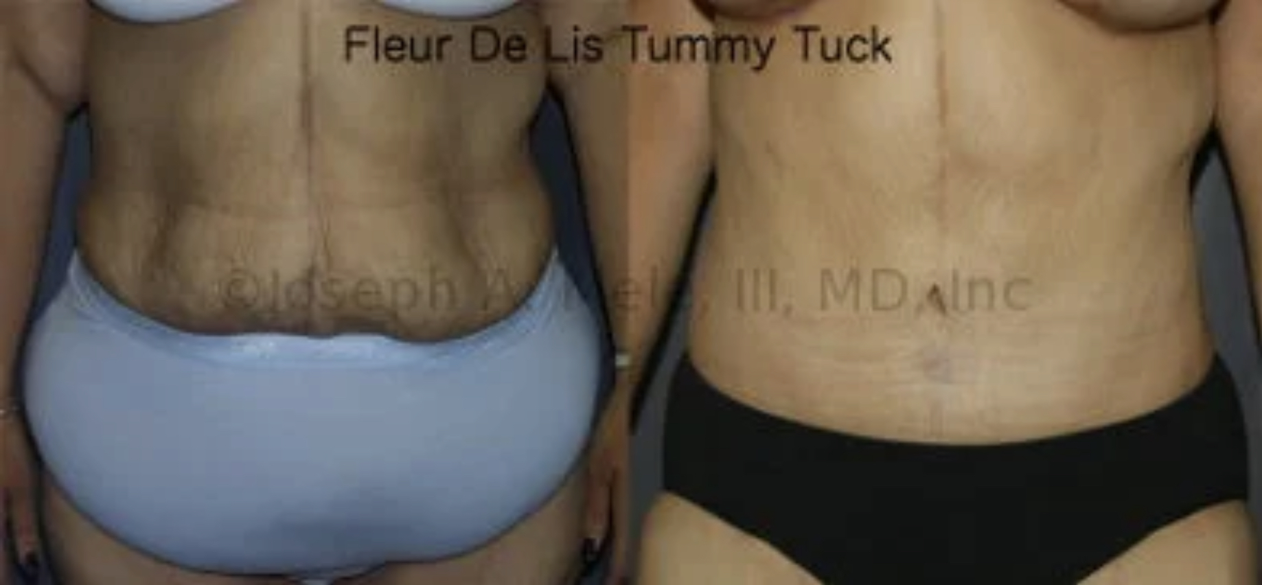 Fleur-de-Lis Abdominoplasty before and after Tummy Tuck post bariatric surgery