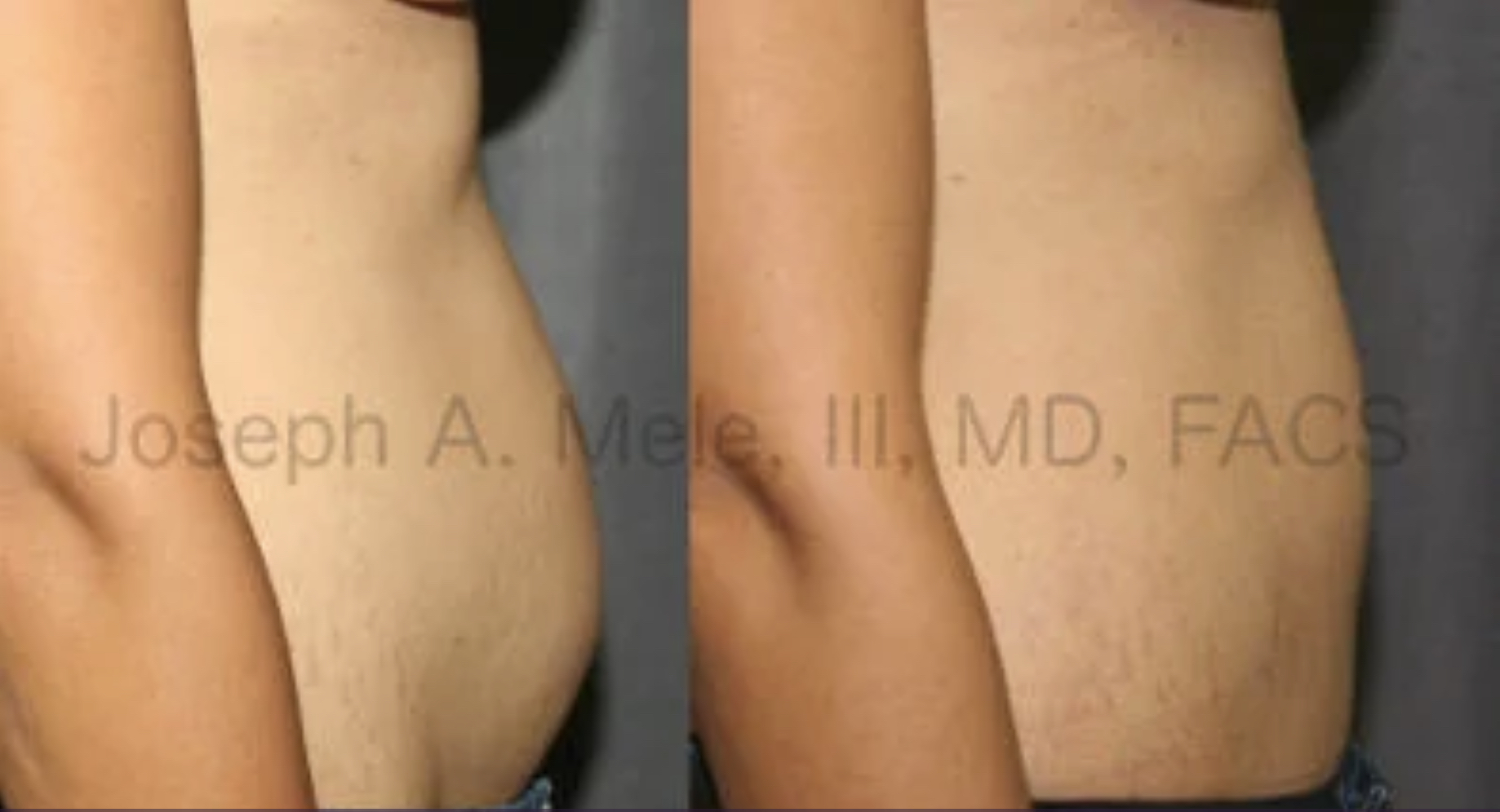 Mini Abdominoplasty before and after Mini Tummy Tuck plastic surgery
