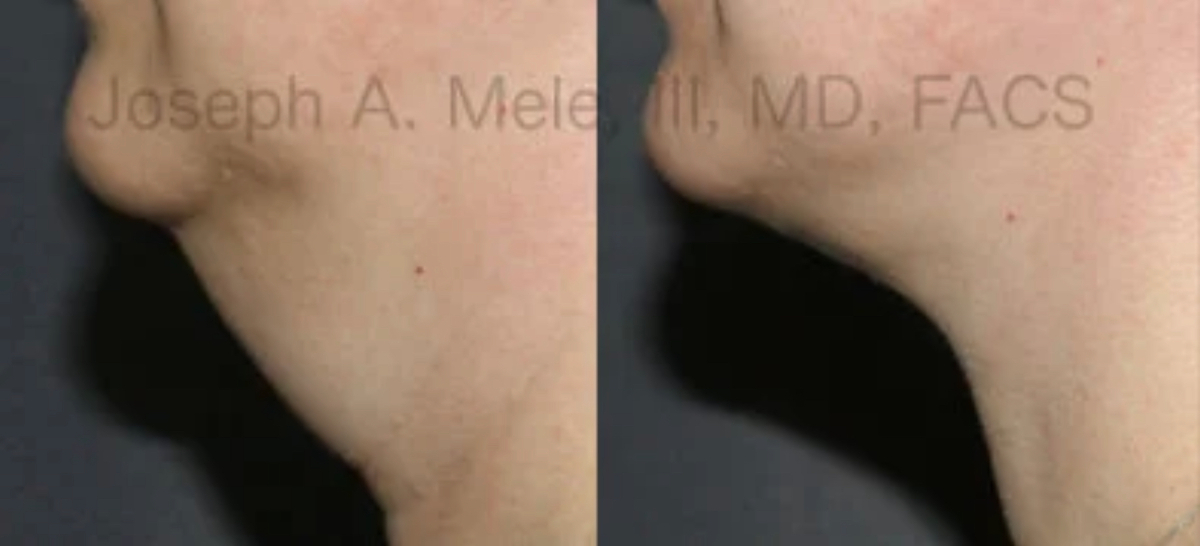 Neck Lift before and after showing tightening of loose neck skin (side view).