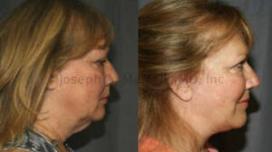 Rhytidectomy before and after photos showing improvement in the face, jawline and neck profiles.