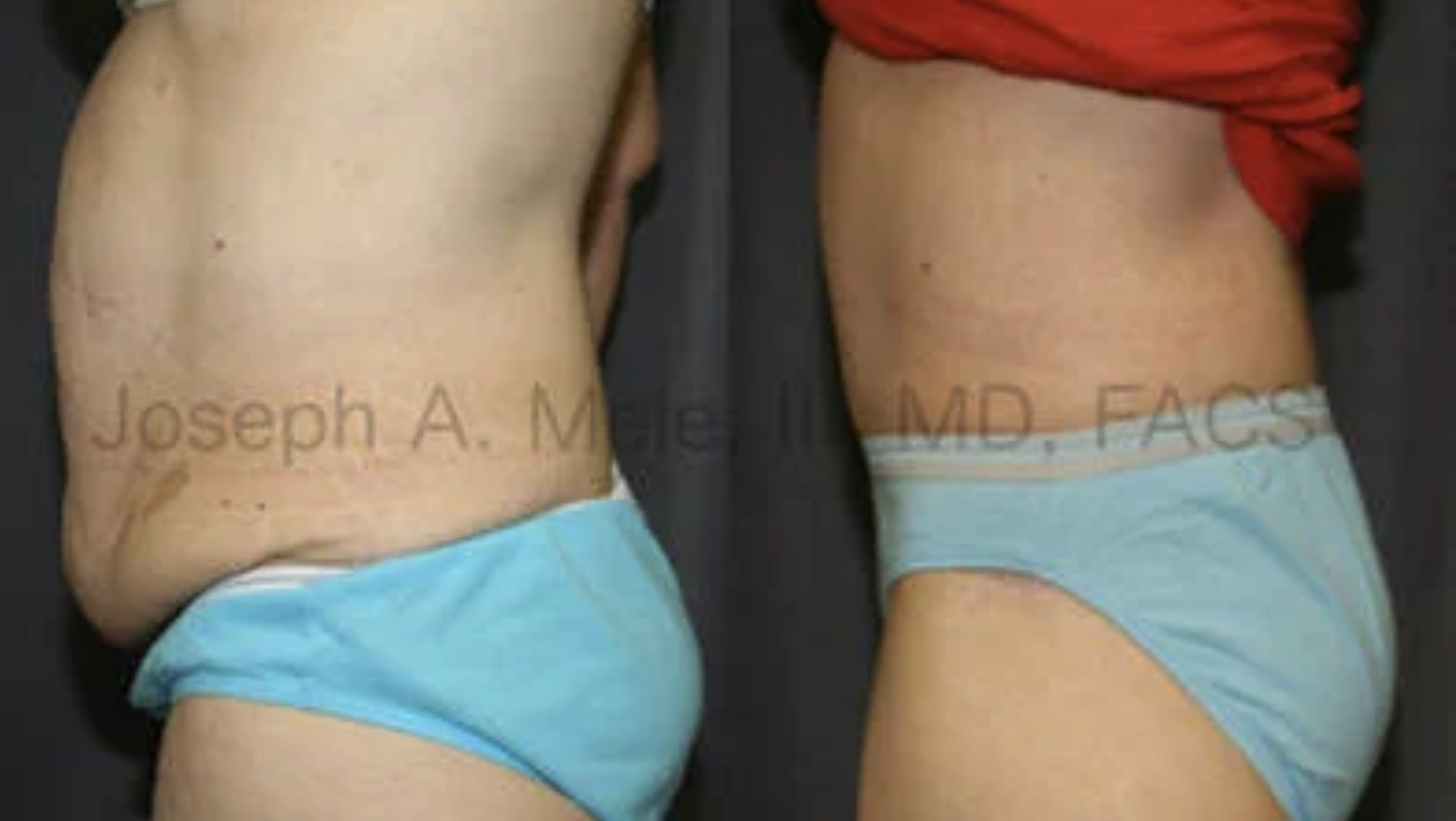 Tummy Tuck before and after Abdominoplasty to tighten the abdominal wall.