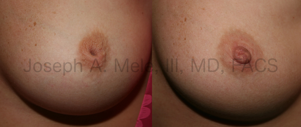 Inverted Nipple Repair - Before and After Surgery