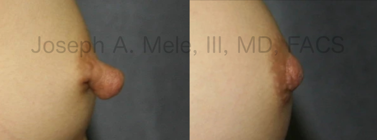 Nipple Reduction Surgery - Before and After Pictures