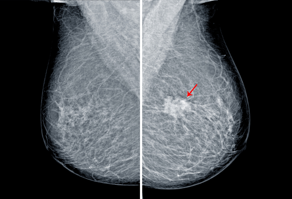 Mammogram for breast cancer screening - positive