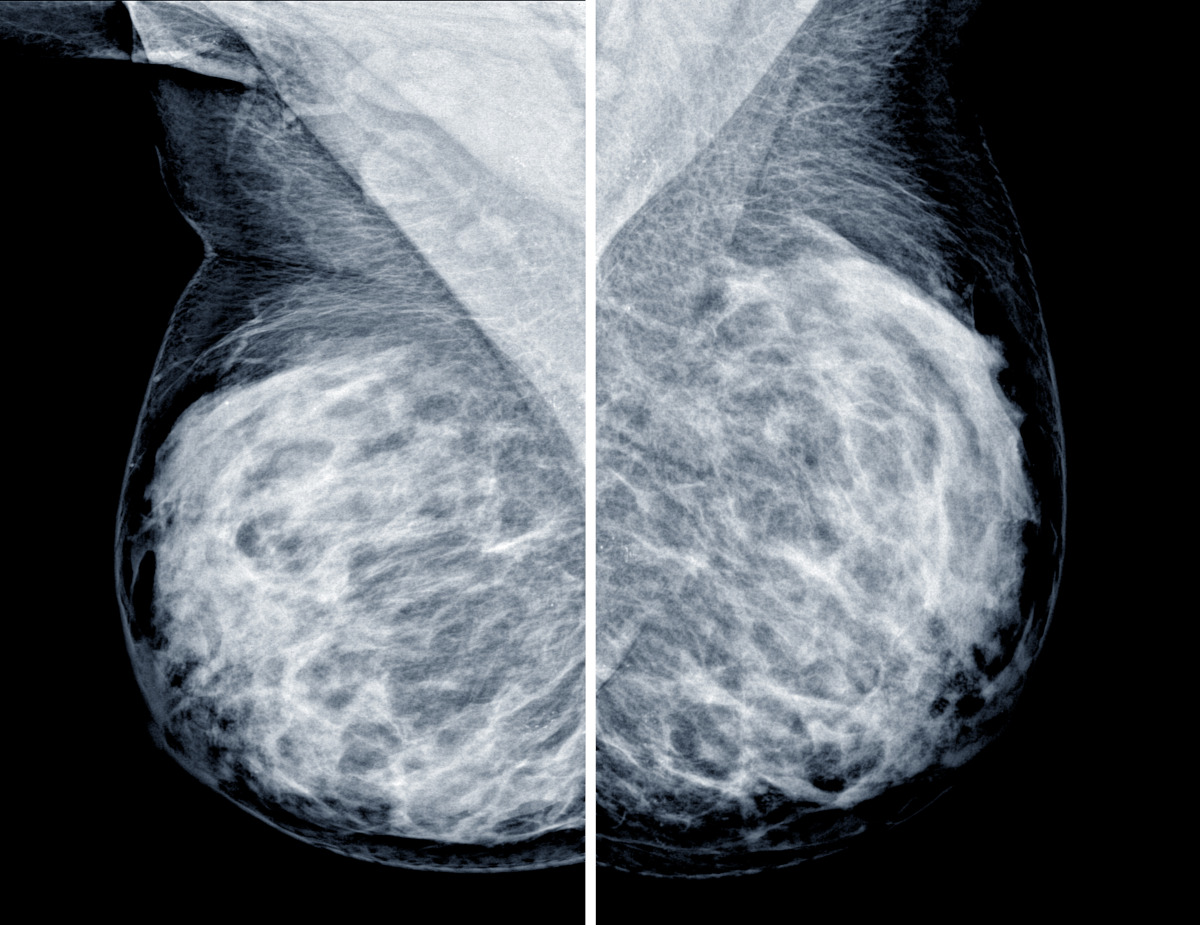 Mammogram for breast cancer screening - dense breasts