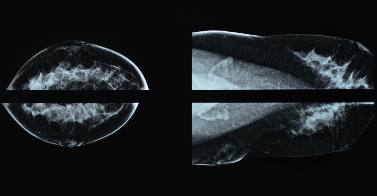 Mammography - screening for breast cancer - small breasts