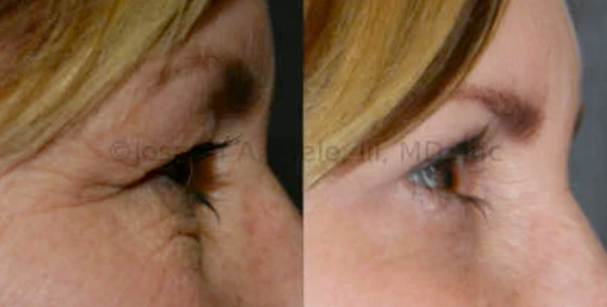 Blepharoplasty before and after pictures upper and lower eyelid lifts