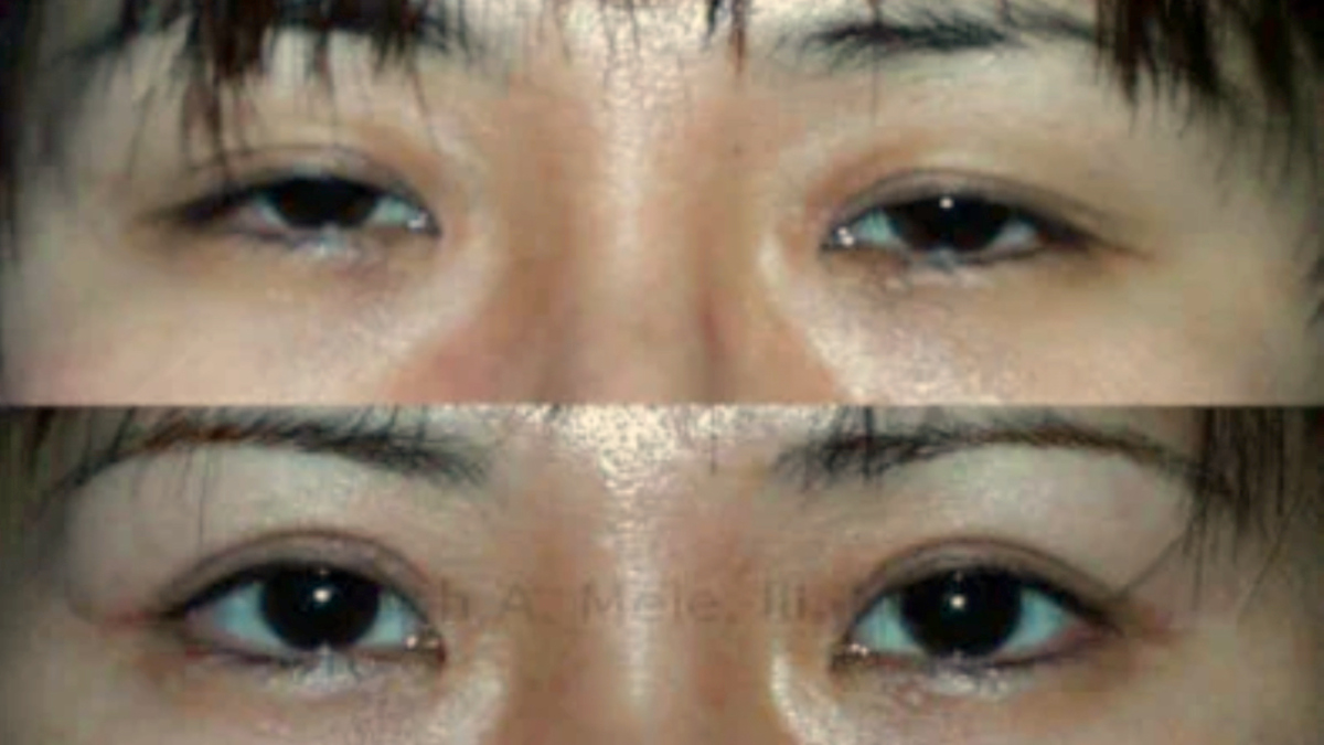 Asian Eyelid before and after pictures to create a double eyelid