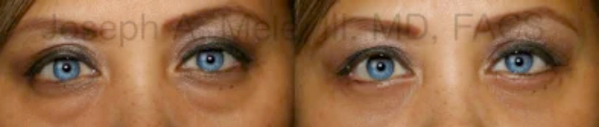 Lower blepharoplasty before and after pictures show removal of lower eyelid bags.