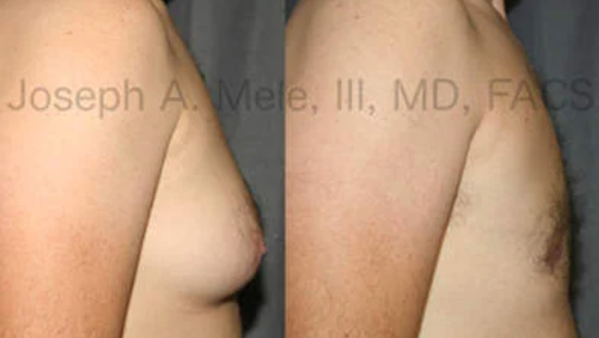 Male Breast Reduction Gynecomastia before and after pictures