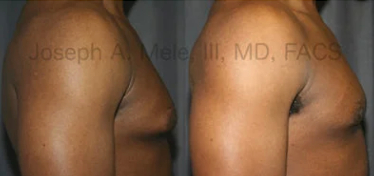 Male Breast Reduction Gynecomastia before and after pictures