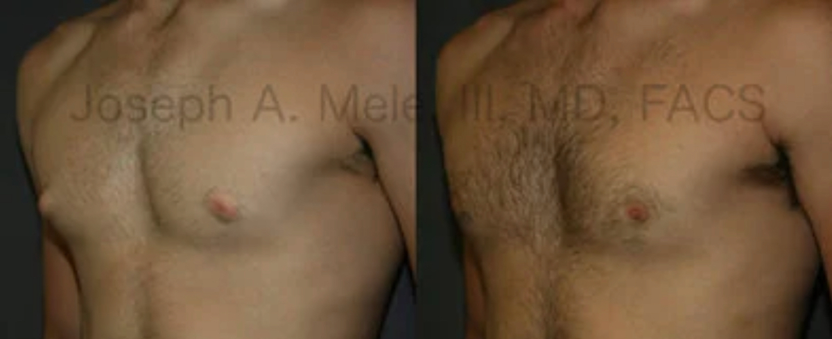 Male Breast Reduction Gynecomastia before and after pictures